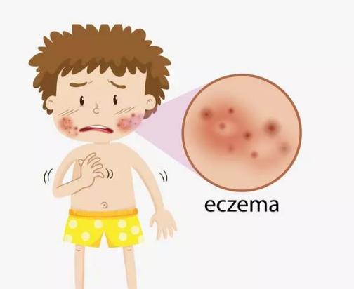 长沙月嫂该如何处理宝宝“湿疹”来袭，从容应对有妙招！(图1)